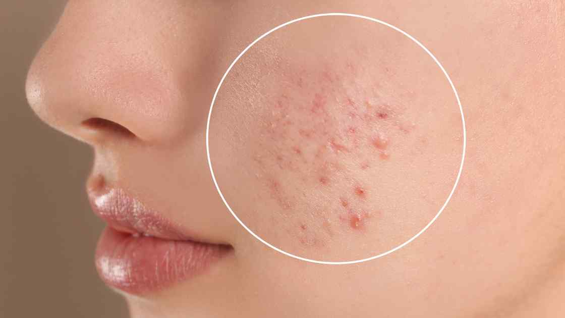 Acne Treatment in Thane