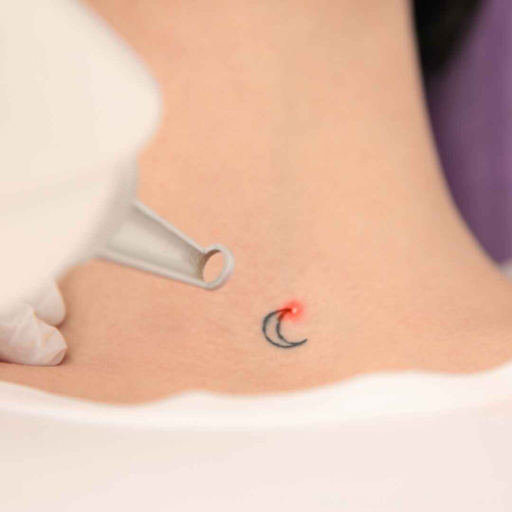 CO2 Laser Treatment for Tattoo Removal