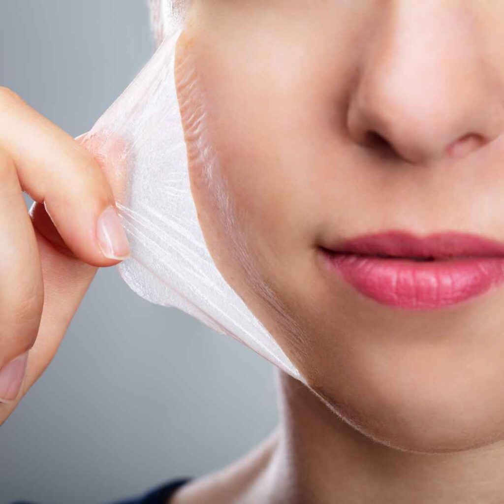 Chemical Peel Tattoo Removal