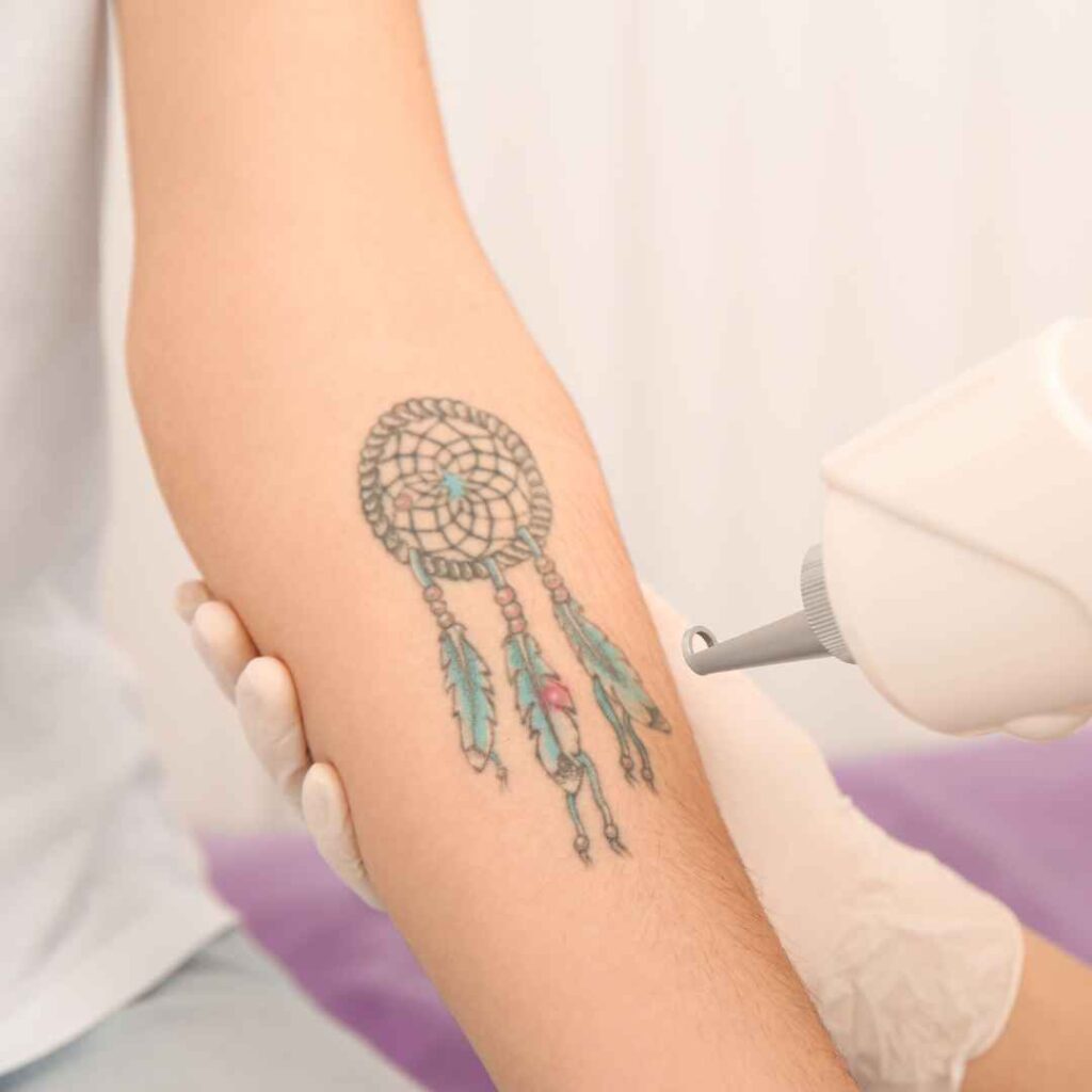 Combination Laser Treatments for Tattoo Removal