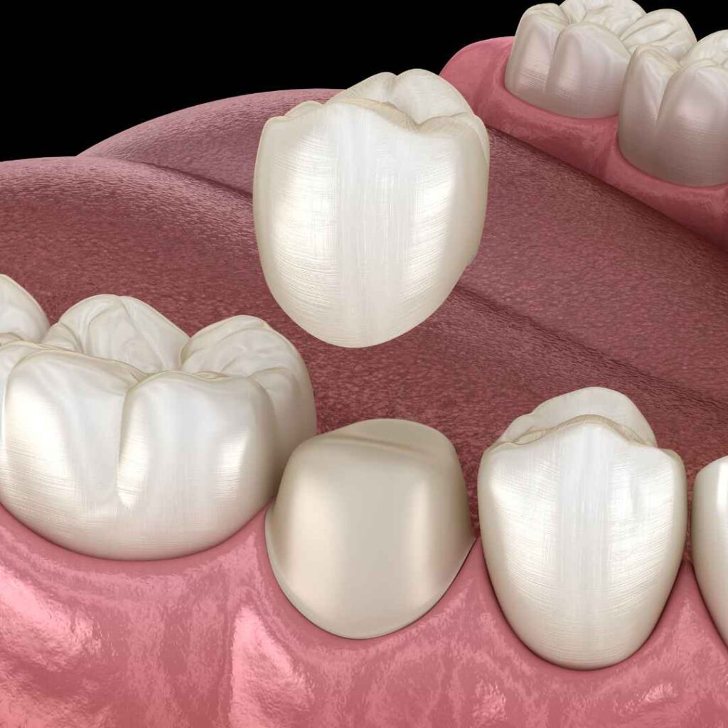 Cosmetic Dentist in Thane 7 Dental Crowns in Thane