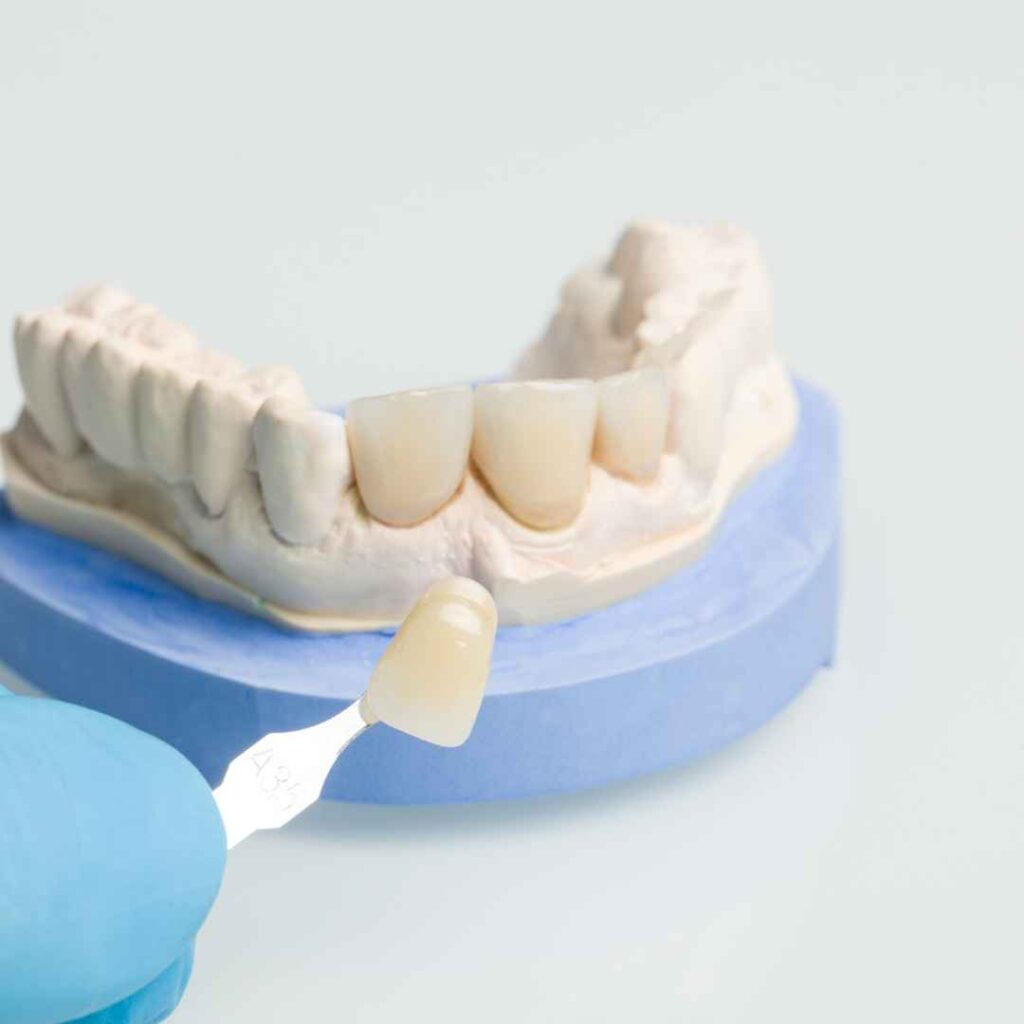 Cosmetic Dentist in Thane 5 Dental Veneers in Thane