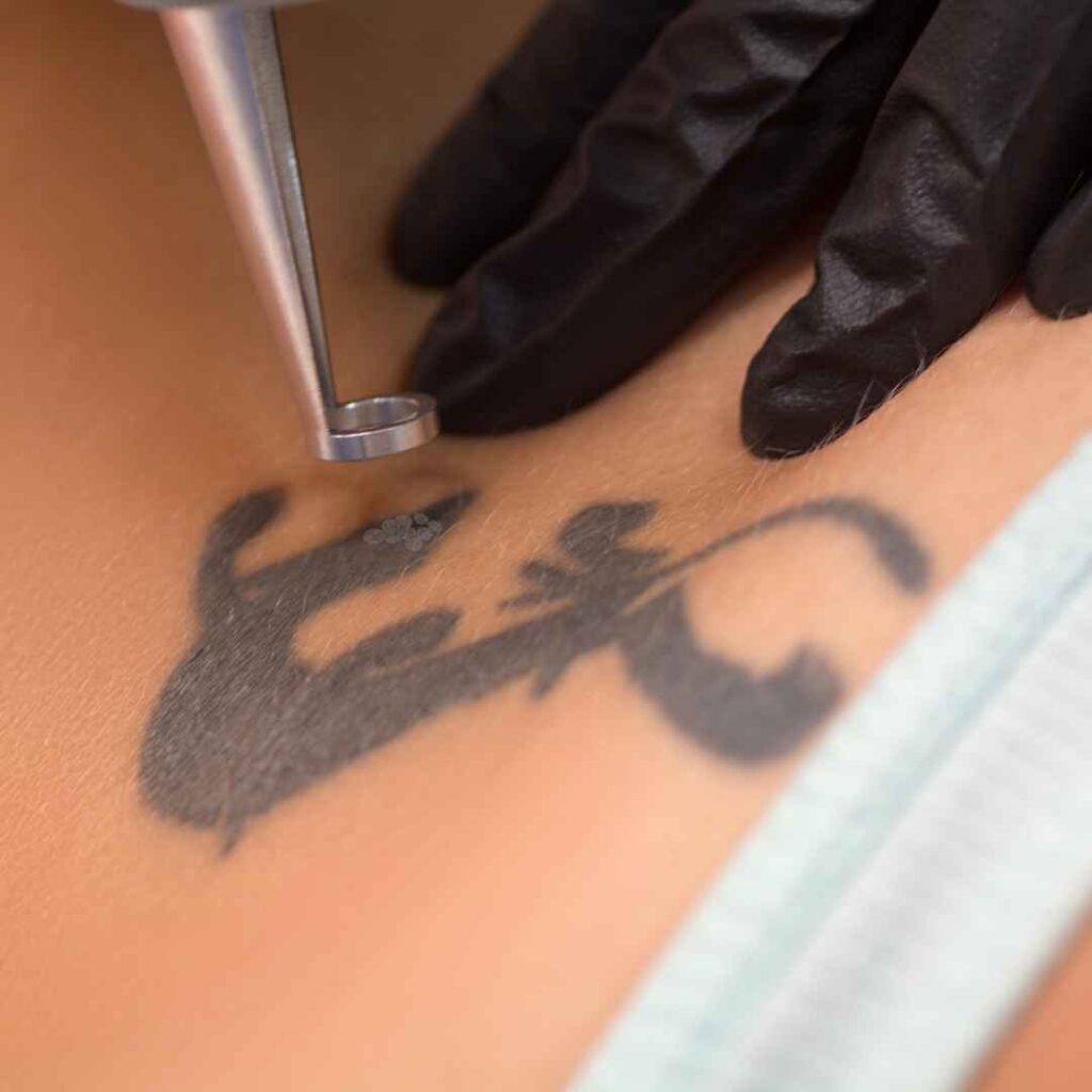 Dermabrasion Tattoo Removal