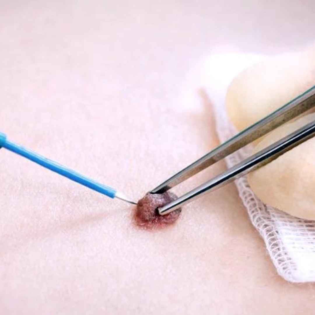 Electrosurgery and Curettage for Wart Removal in Thane