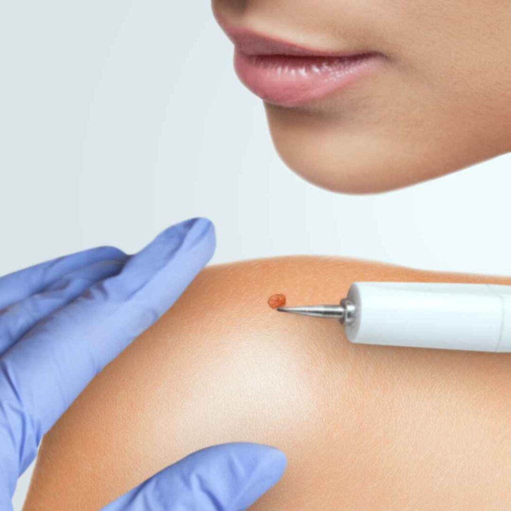 Excision for Wart Removal in Thane