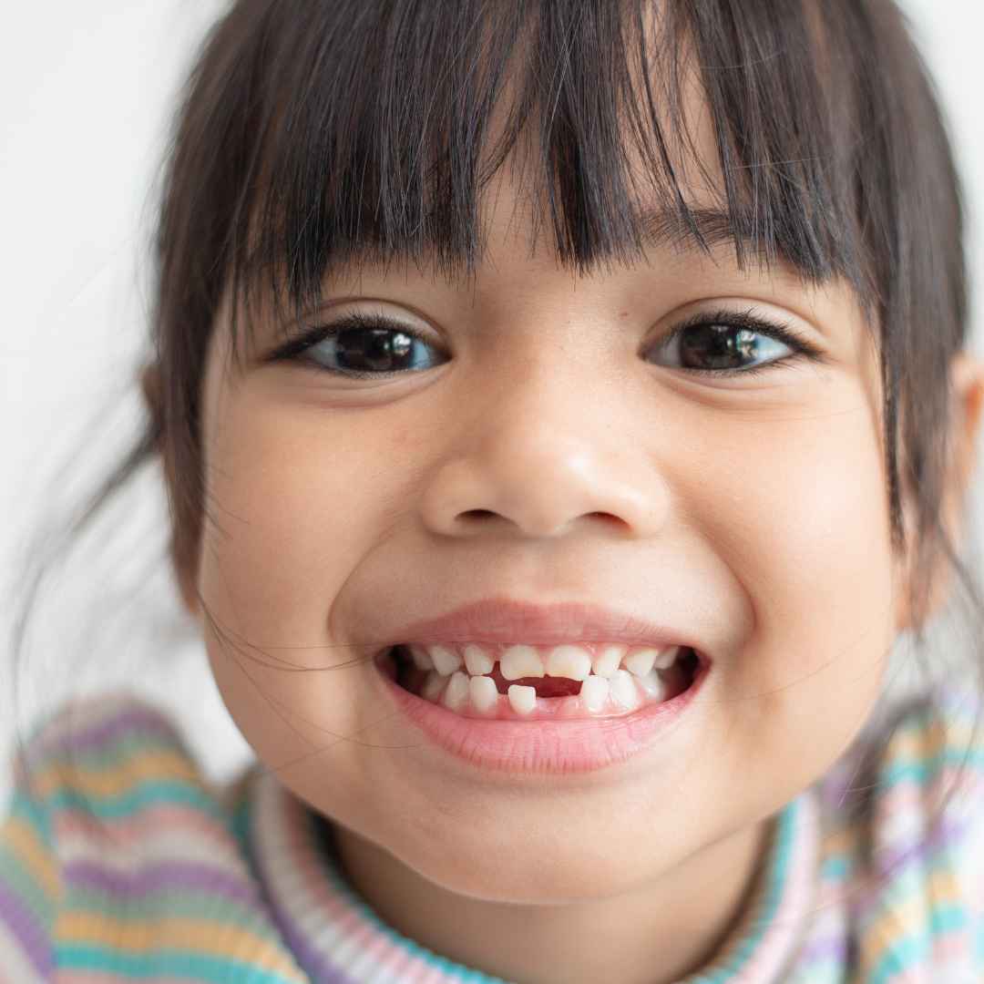 Best Family Dentist in Rabodi, Thane 3 Fluoride Treatments in Thane