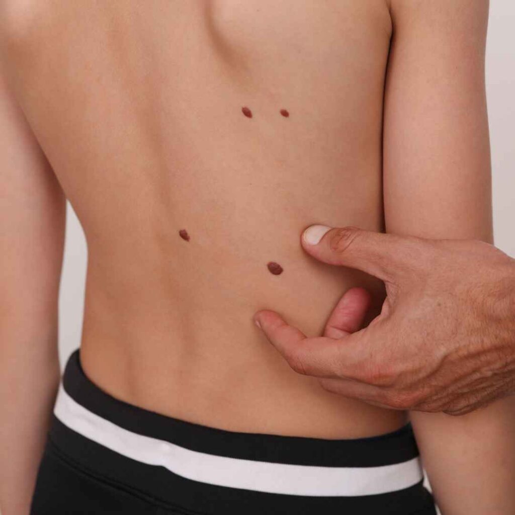 Fractional CO2 Laser Treatment in Thane