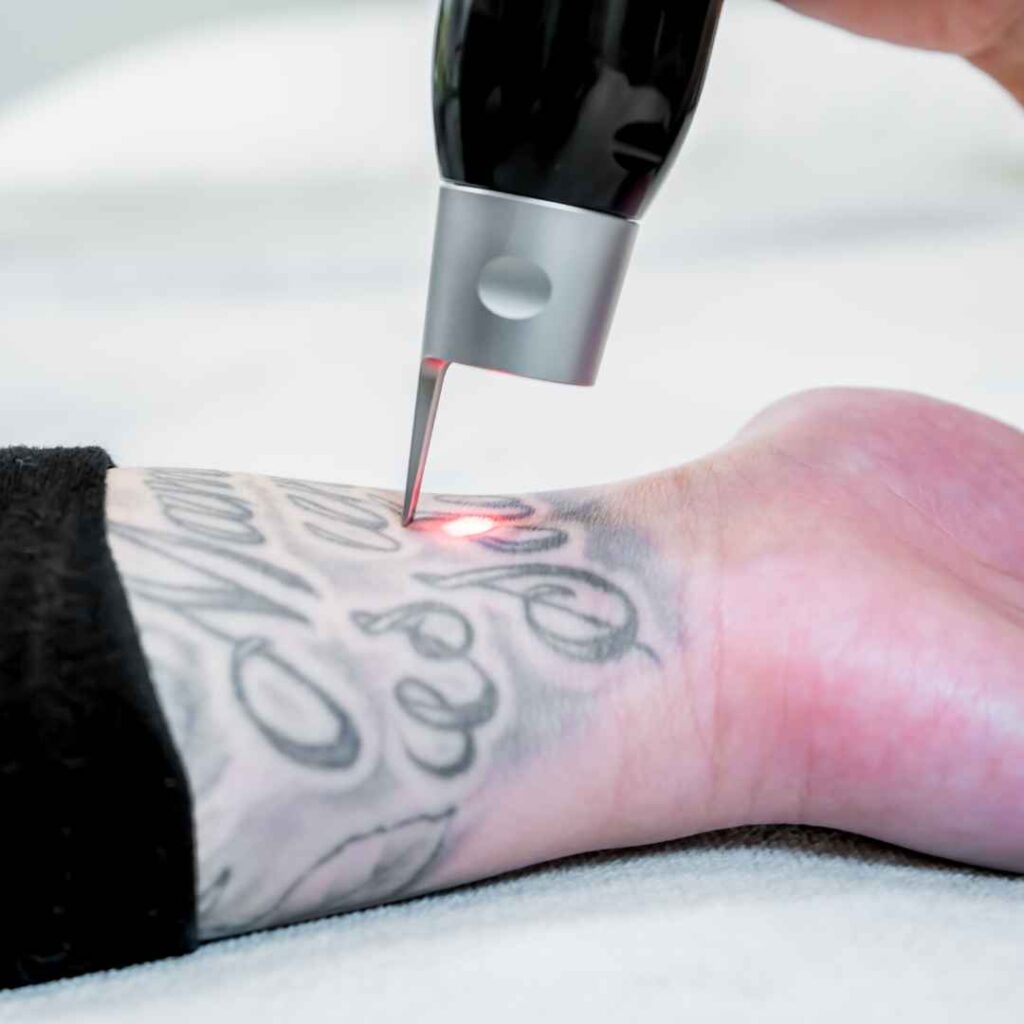 Fractional Laser Treatment for Tattoo Removal
