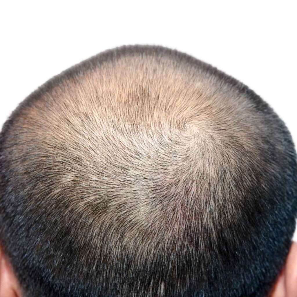 Inherited Hair Loss Treatment