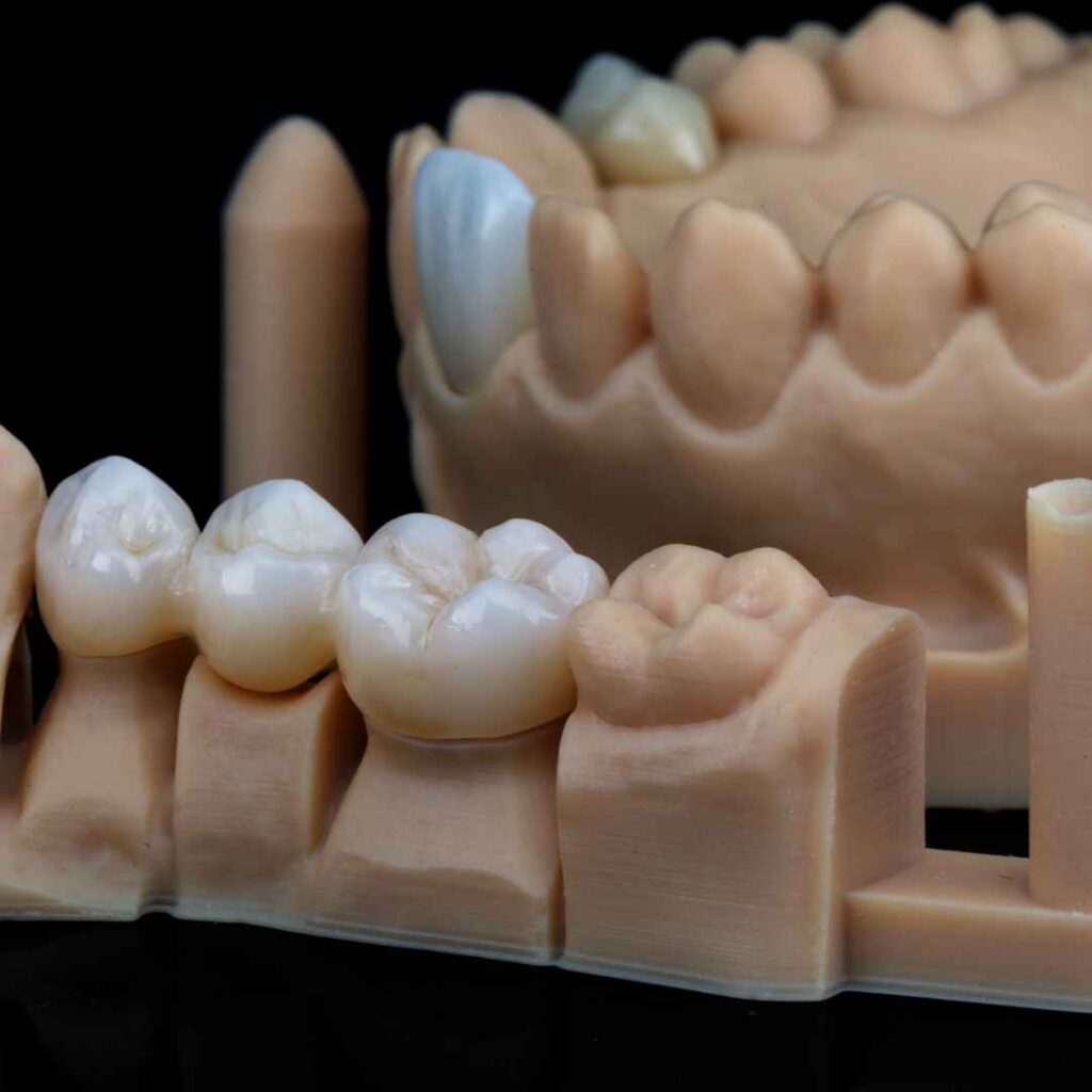 Cosmetic Dentist in Thane 8 Inlays and Onlays in Thane