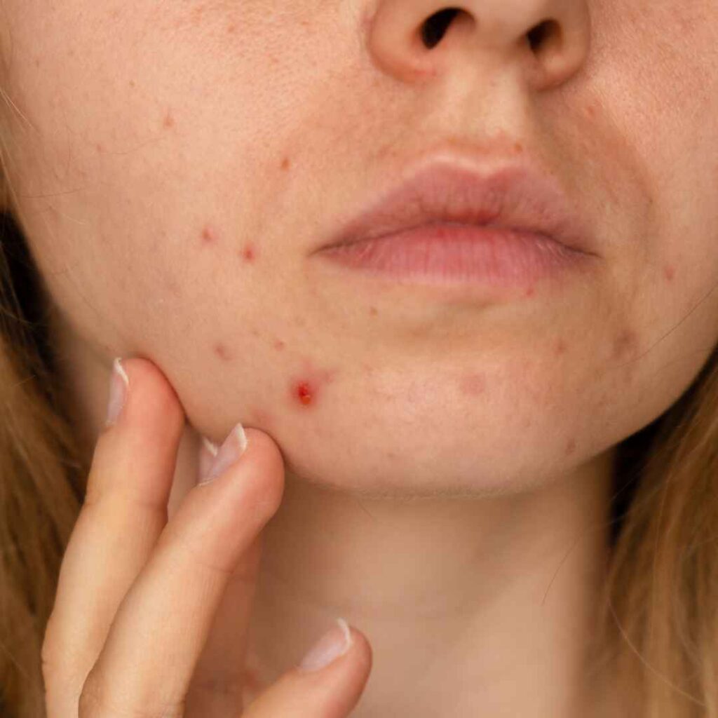 Intensive Spot Treatment in Thane