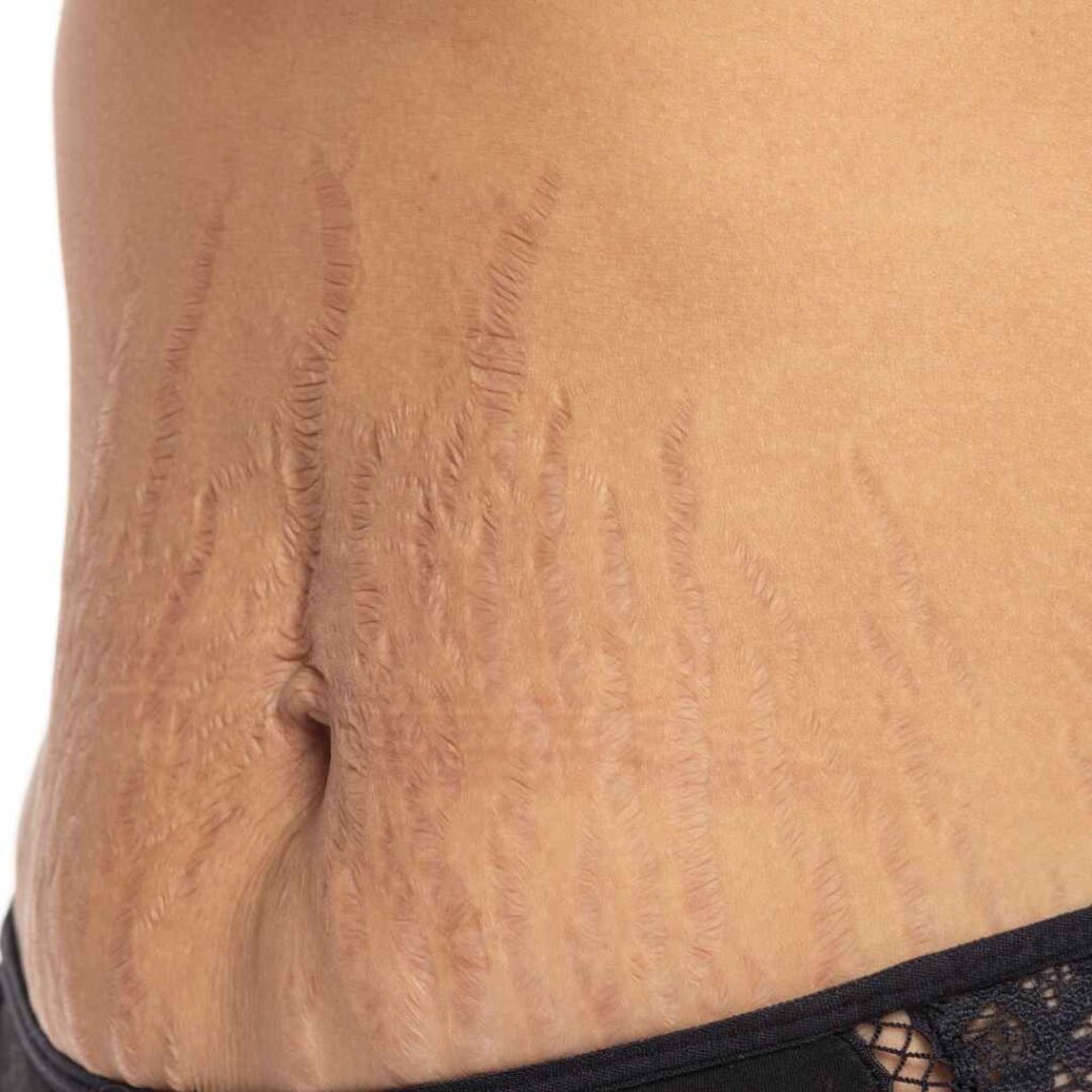 Stretch Marks Treatment in Thane 2 Introduction Stretch Mark Treatment in Thane