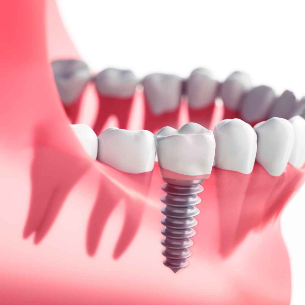 Introduction to Dental Implants at Thane