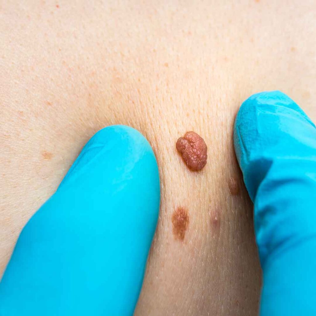 Introduction to Skin Tag and DPN Removal in Thane