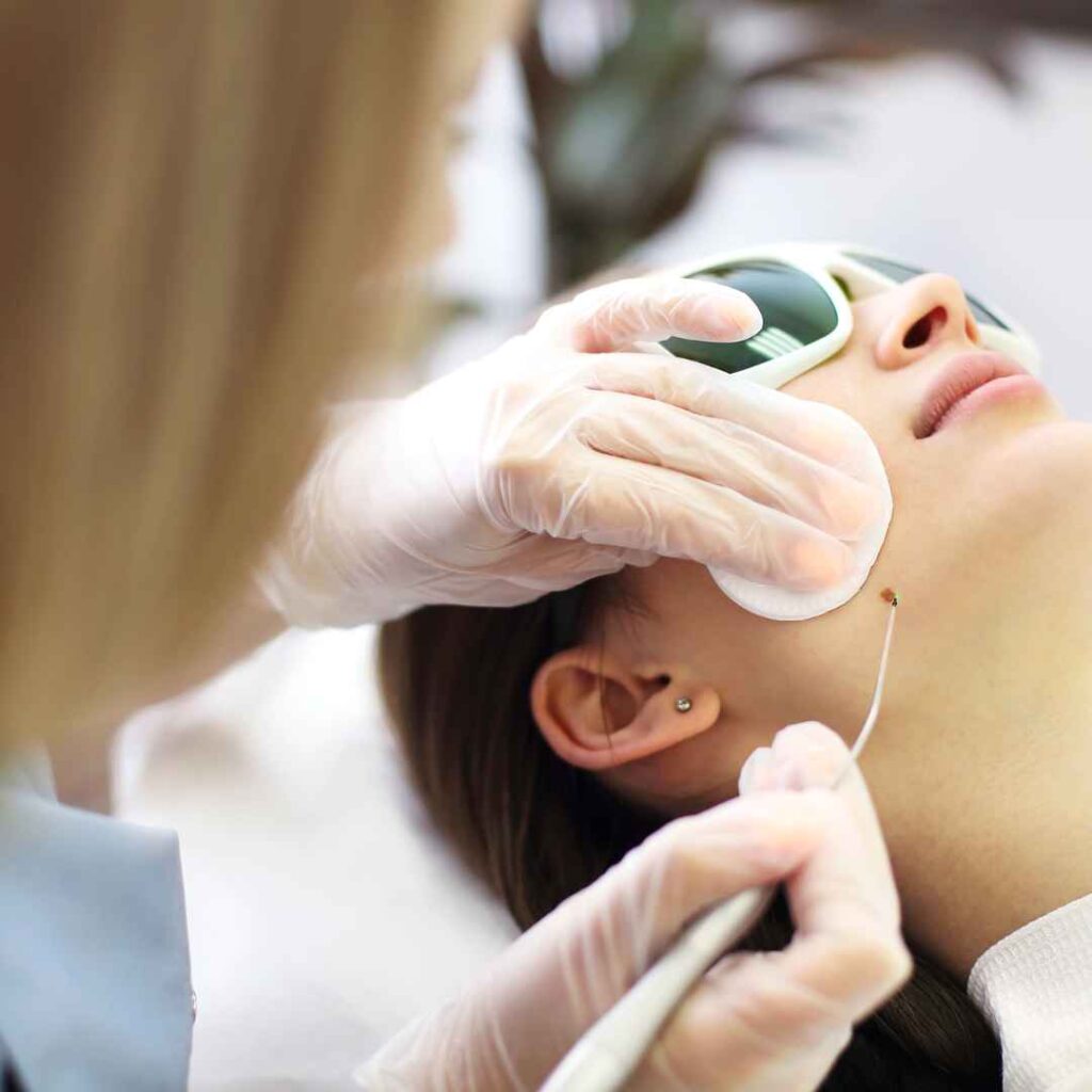 Introduction to Wart Removal at Thane