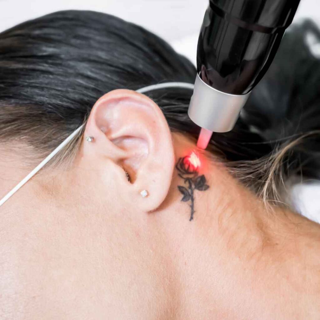 Laser Tattoo Removal