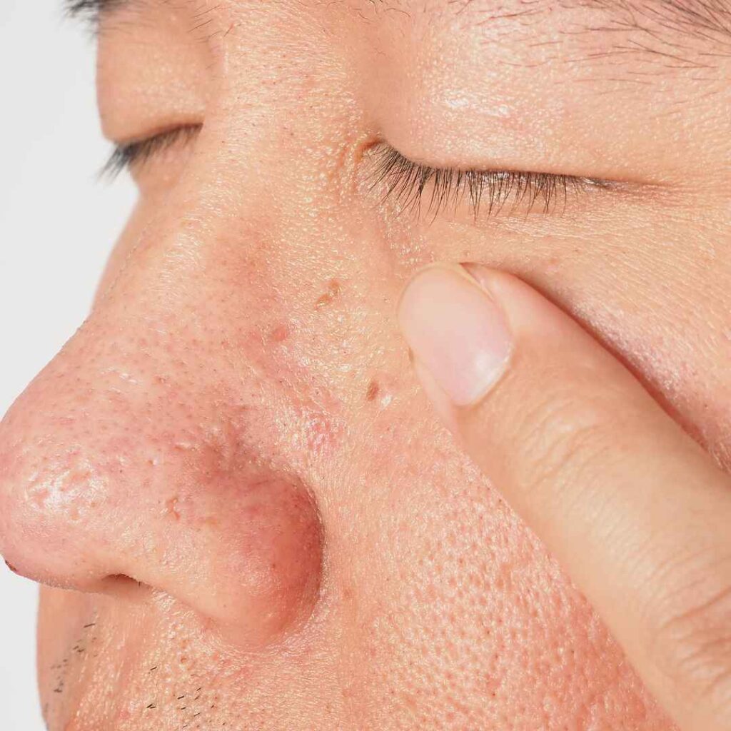 Laser Treatment for Wart Removal in Thane
