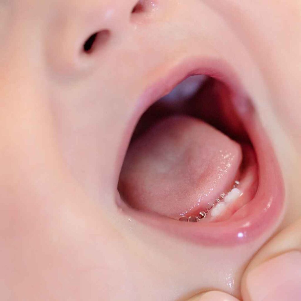 Management of Gum Diseases in Thane