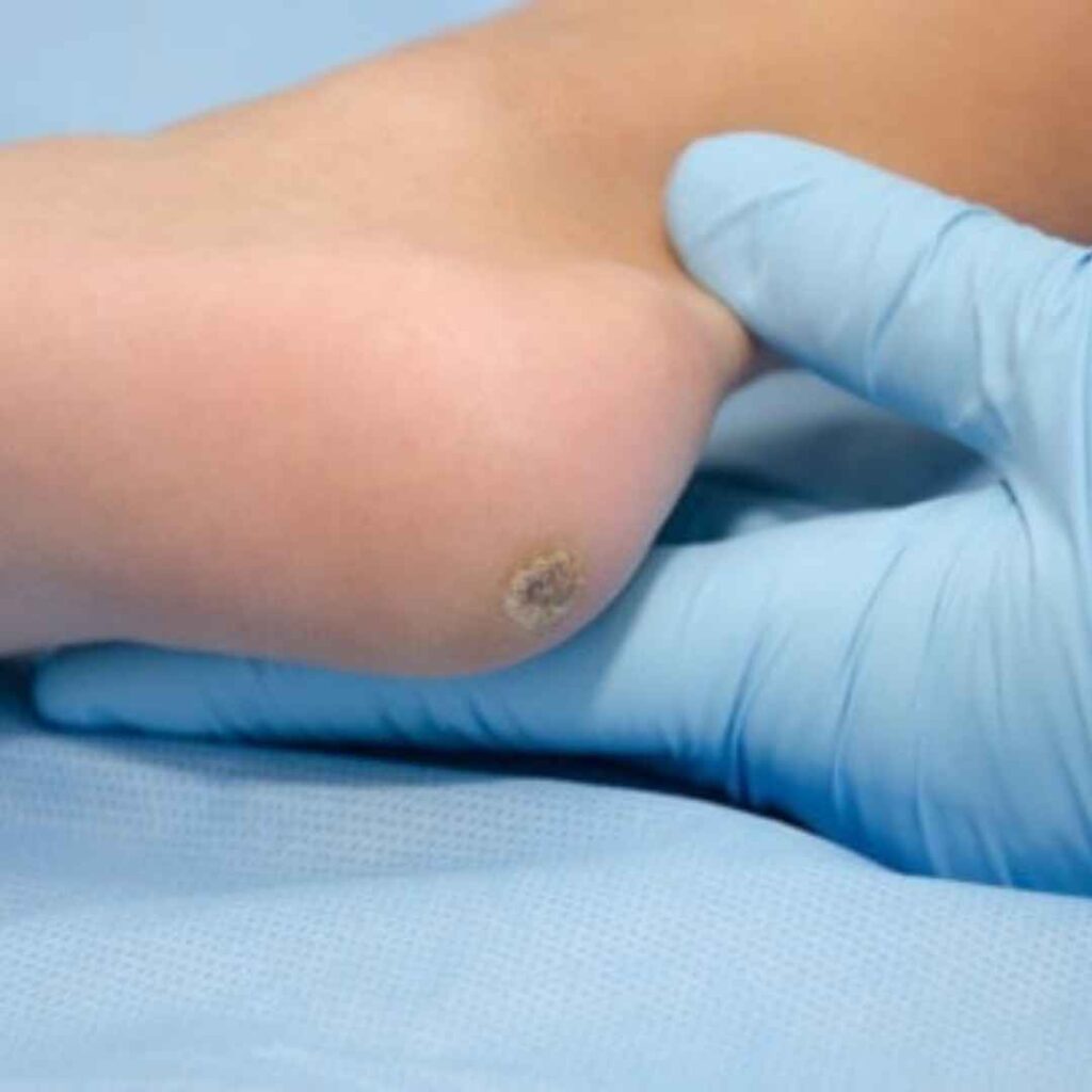 Minor Surgery for Wart Removal in Thane