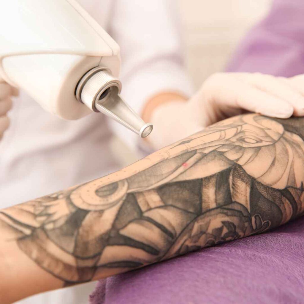 Multiple-Pass Laser Methods for Tattoo Removal