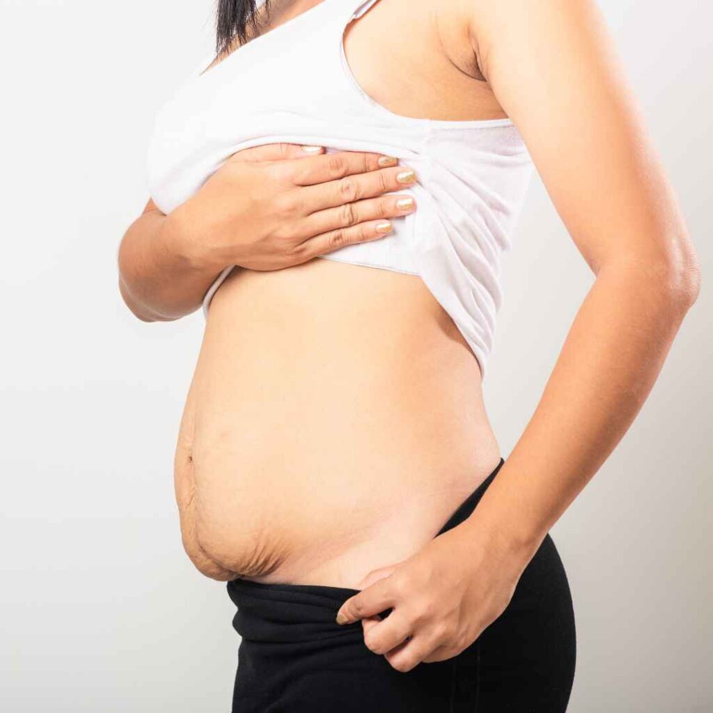 Stretch Marks Treatment in Thane 20 Oxygen Therapy Skin Rejuvenation for Stretch Marks
