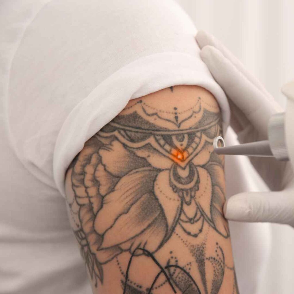 Picosecond Laser Treatment for Tattoo Removal