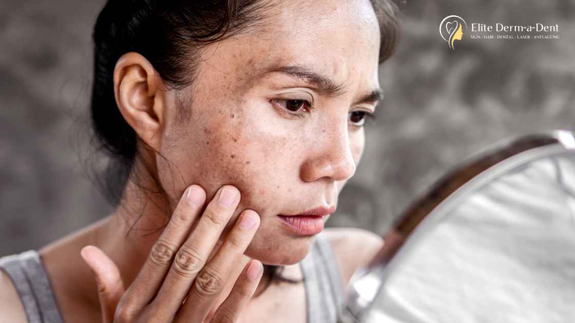 Pigmentation Treatment in Thane