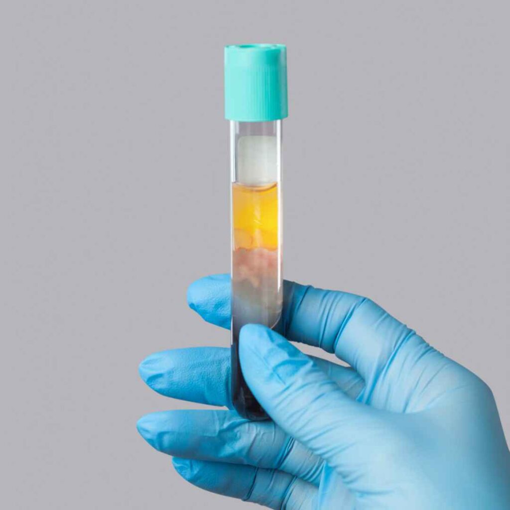 Stretch Marks Treatment in Thane 13 Platelet-Rich Plasma Therapy for Stretch Marks