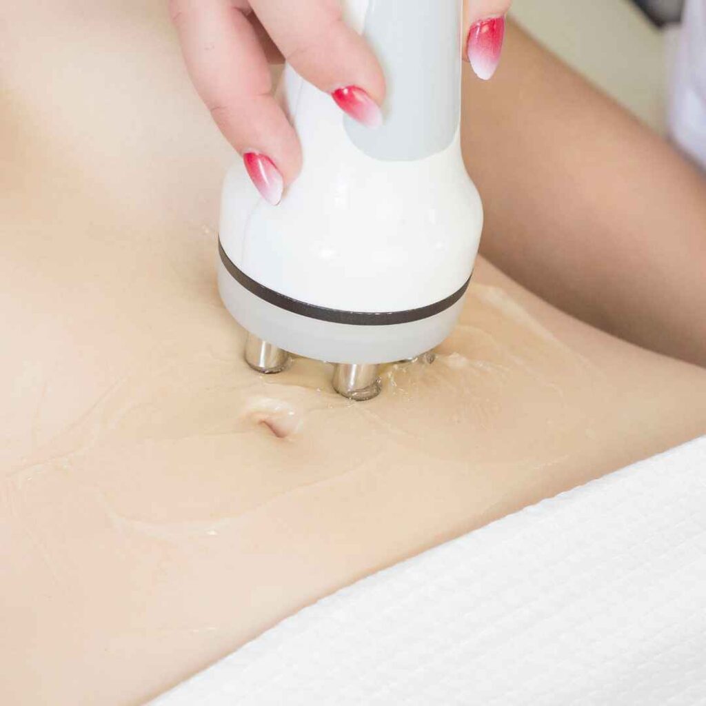 Stretch Marks Treatment in Thane 7 Radiofrequency Therapy for Stretch Marks