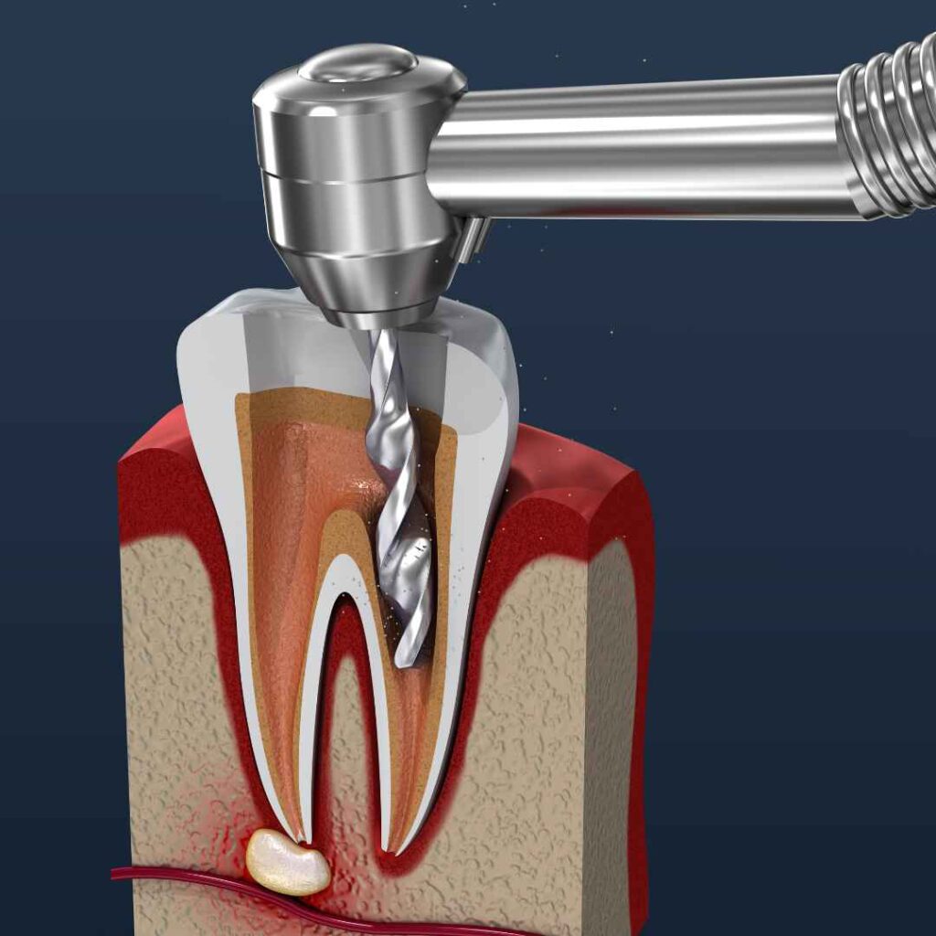 Root Canal Treatment in Thane