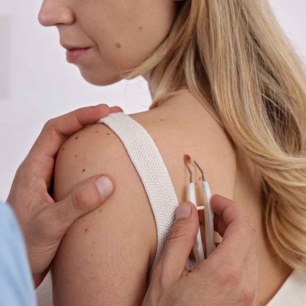 Shave Excision in Thane