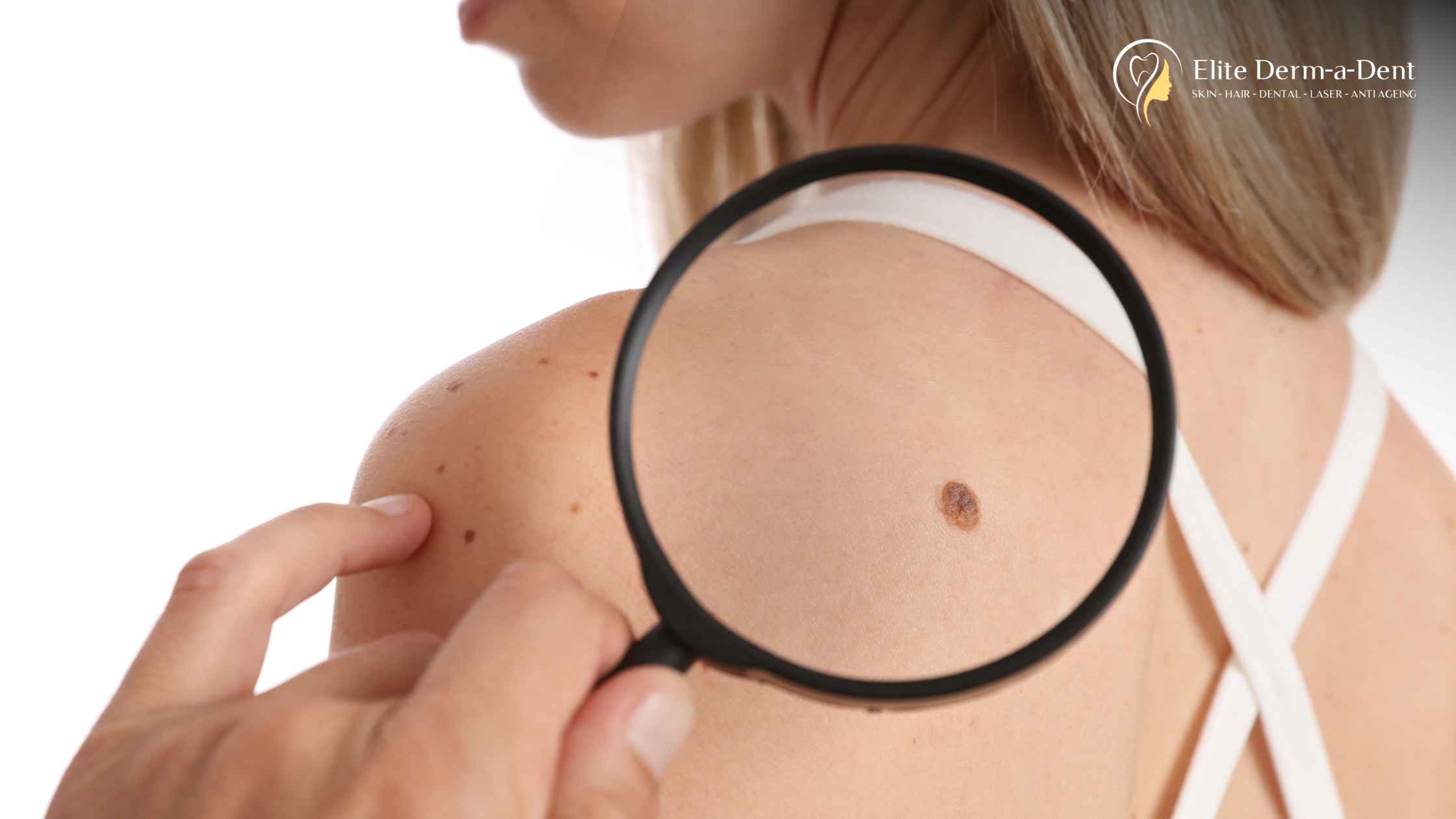 Skin Tag and DPN Removal in Thane