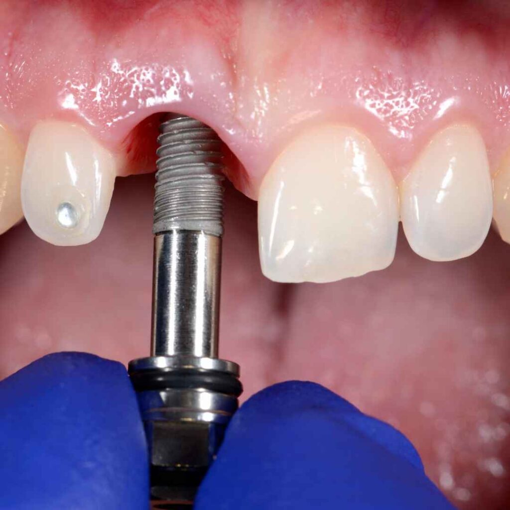 Surgical Procedure and Healing
