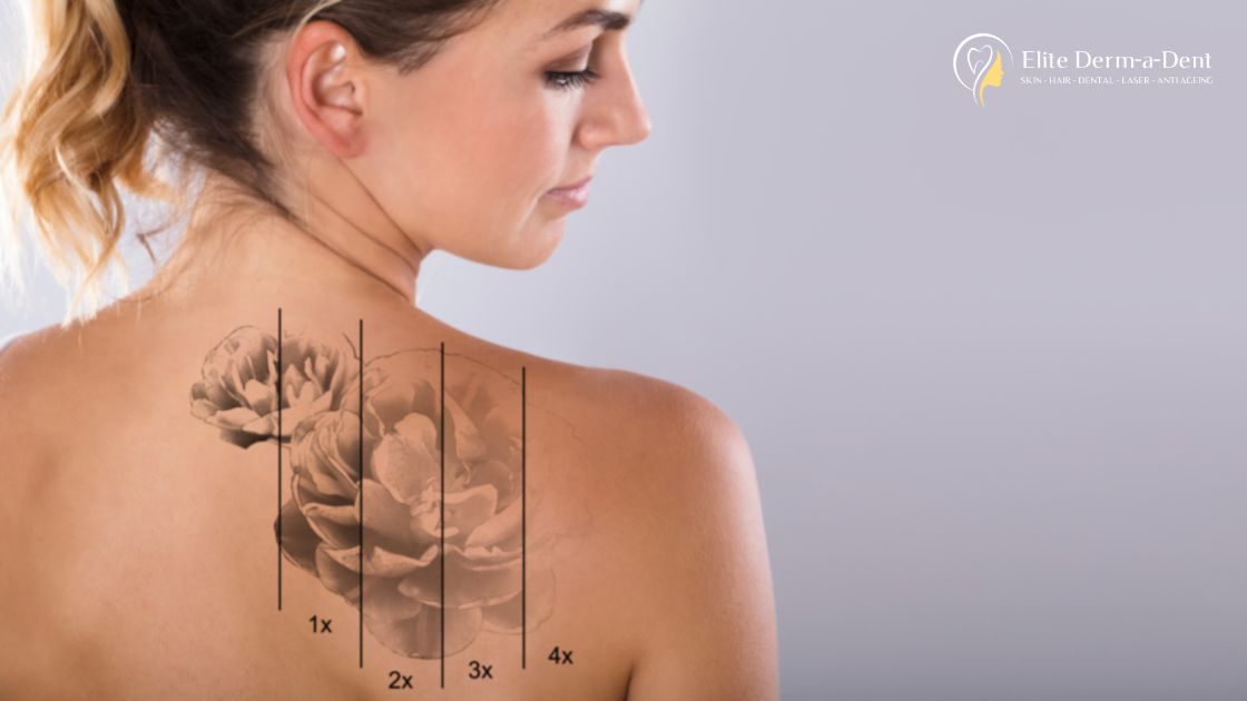 Tattoo Removal in Thane
