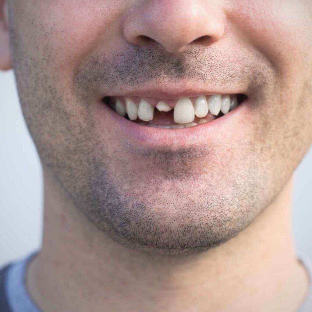 Treatment of Cracked Teeth