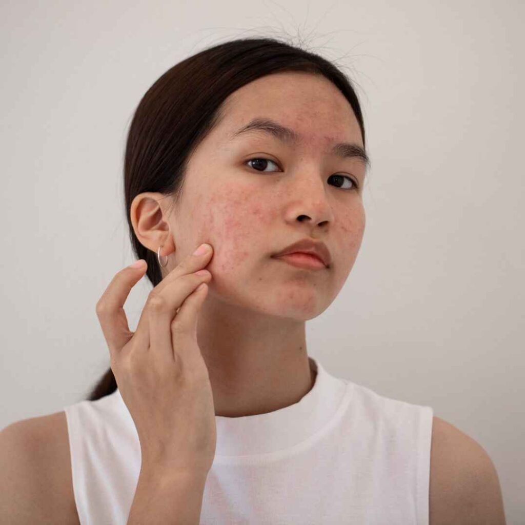 Acne Treatment in Thane