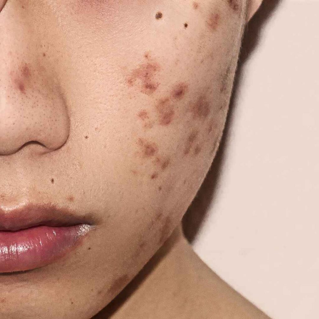 Advanced Acne Scar Treatments in Thane