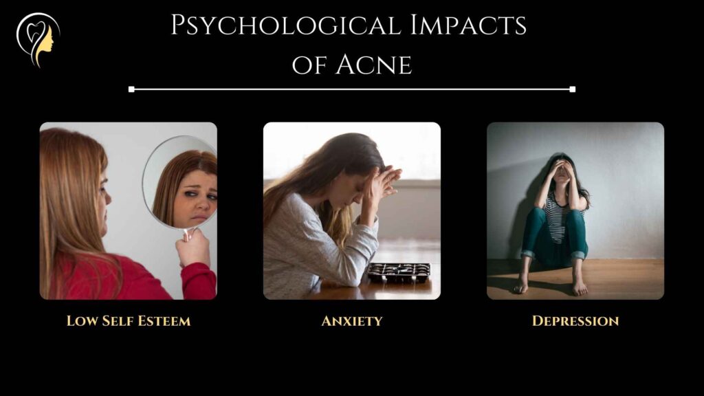 Types of Acne (2024) | Dr. Arefa Patel 6 Psychological Impacts of Acne, Low Self Esteem, Anxiety, Depression