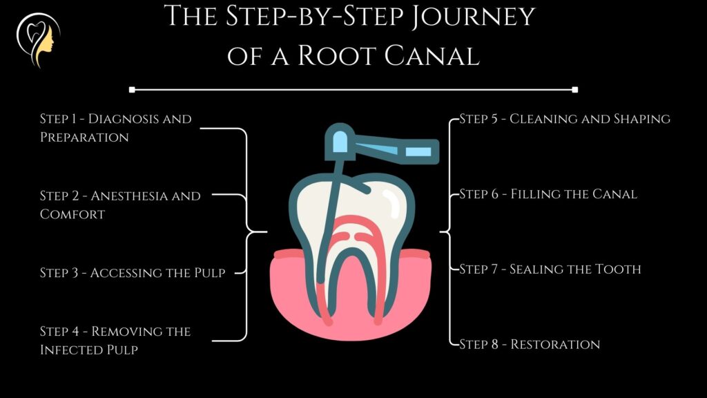 What is Root Canal? A Comprehensive Guide (2024) by Dr Saurabh Pakhale 3 The Step-by-Step Journey of a Root Canal