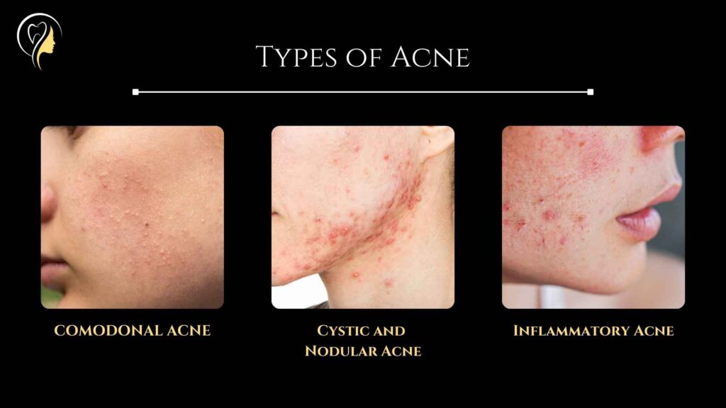 Types of Acne (2024) | Dr. Arefa Patel 2 Types of Acne - Comodonal Acne, Cystic and Nodular Acne, Inflammatory Acne