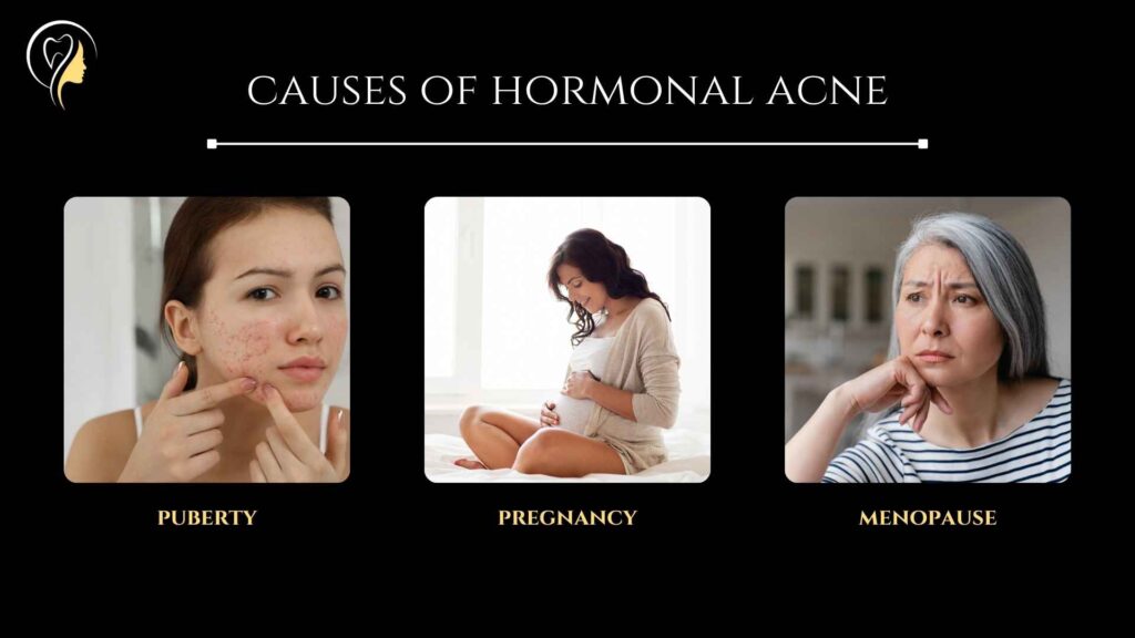 Types of Acne (2024) | Dr. Arefa Patel 3 causes of hormonal acne - Puberty, Pregnancy, Menopause