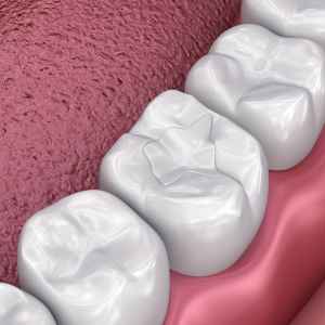 Amalgam Tooth Filling