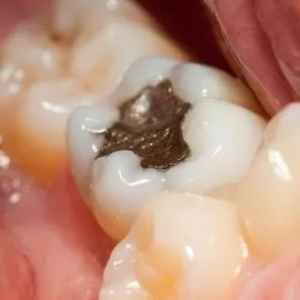 Composite Resin