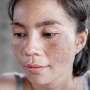 Dark Spots and Hyperpigmentation