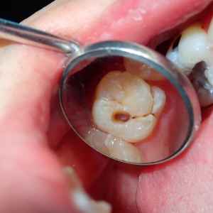 Tooth Extraction in Thane (2024) 5 Detailed Tooth Examination