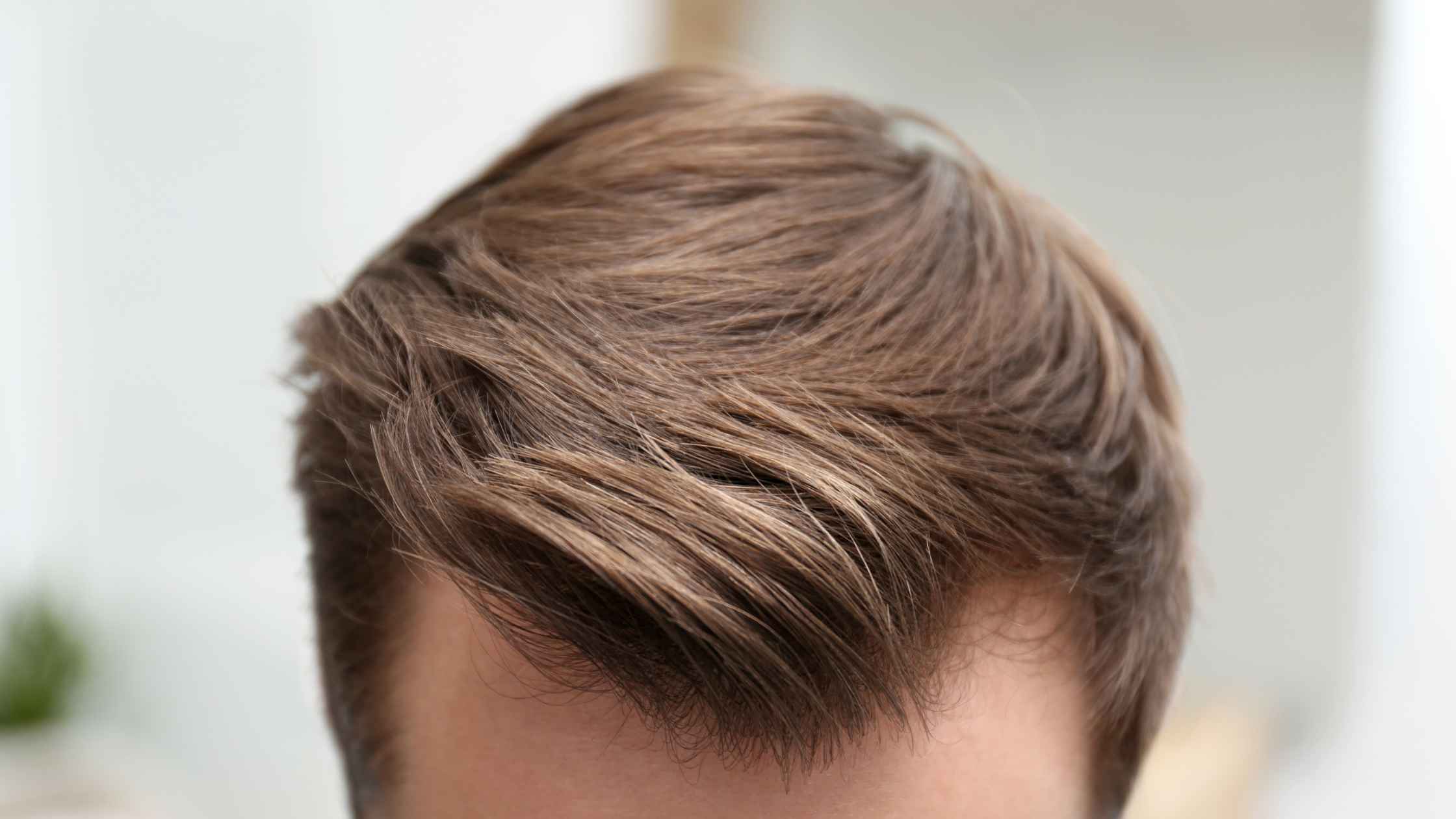 FUE Hair Transplant in Thane