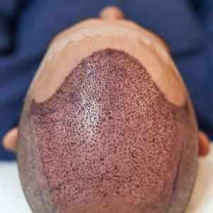 FUE Hair Transplant