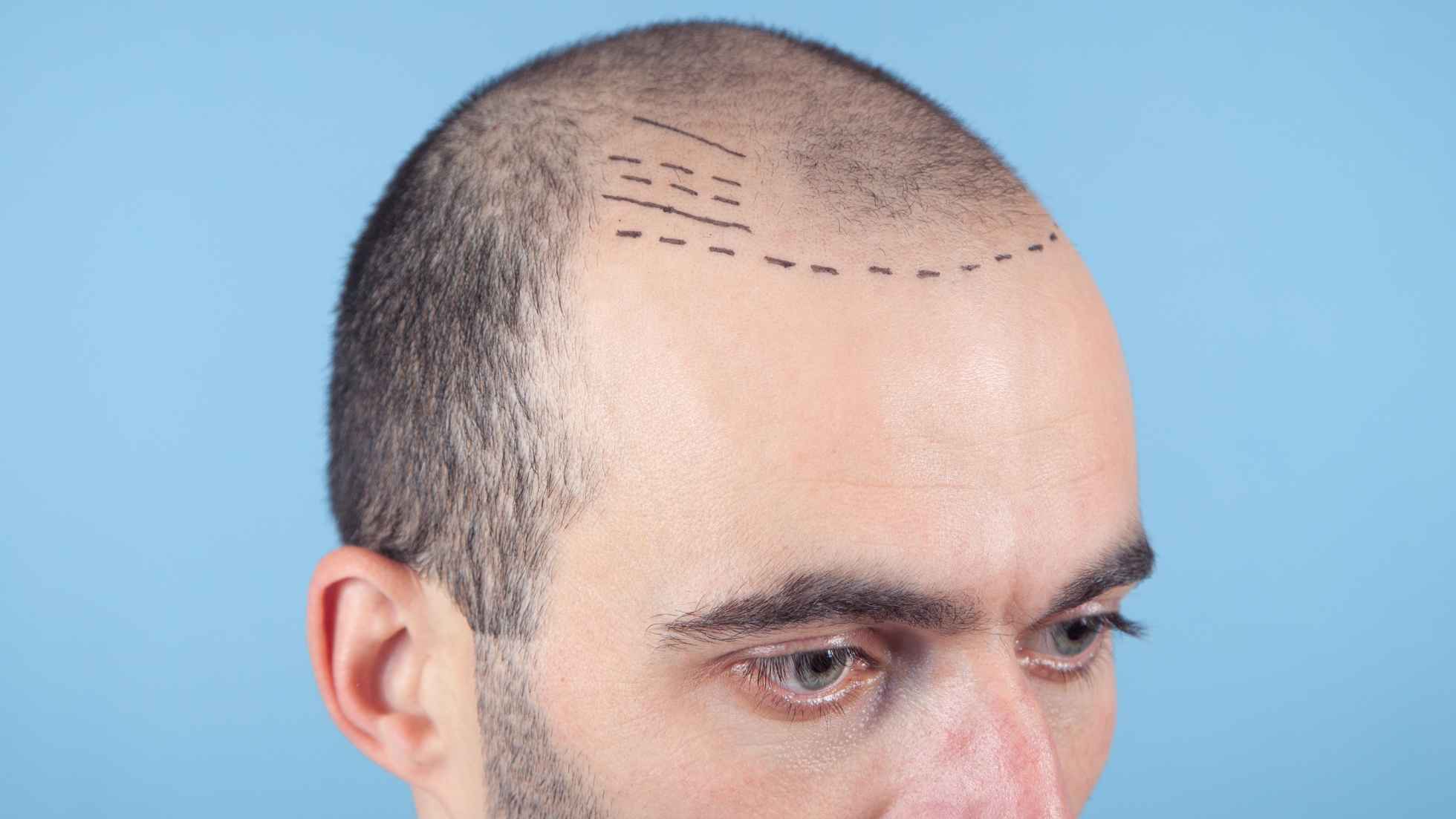 FUT Hair Transplant in Thane