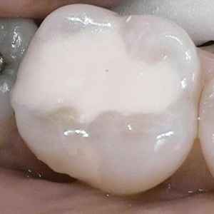 Glass Ionomer