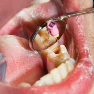 Gold Tooth Filling